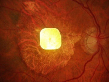 Görmeyi geri getiren çip: PRIMA ile yeniden okumak mümkün gormeyi geri getiren cip prima ile yeniden okumak mumkun bM5fnedF.jpg